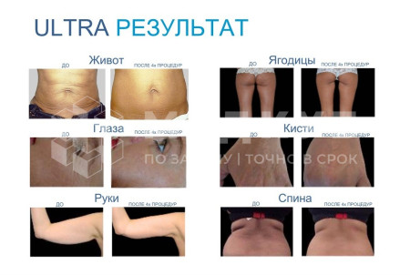 Аппарат RF-лифтинга BTL EXILIS Ultra 360 medcub