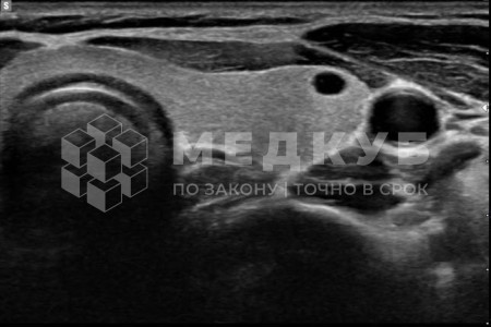 Аппарат УЗИ НПО Сканер РуСкан 65М medcub