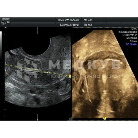 Аппарат УЗИ (сканер) GE Healthcare Voluson P8 medcub