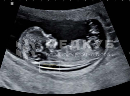 Аппарат УЗИ НПО Сканер РуСкан 65М medcub