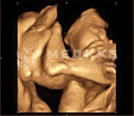 УЗИ-аппарат портативный НПО Сканер РуСкан 70П medcub