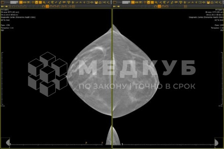 Маммограф рентгеновский с томосинтезом МТЛ Маммо-5МТ medcub