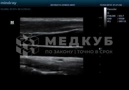 Портативный аппарат УЗИ Mindray TE7 (планшет) medcub