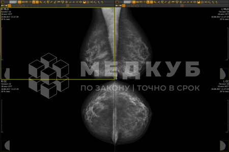 Маммограф рентгеновский МТЛ Маммо-5МТ биопсийный
