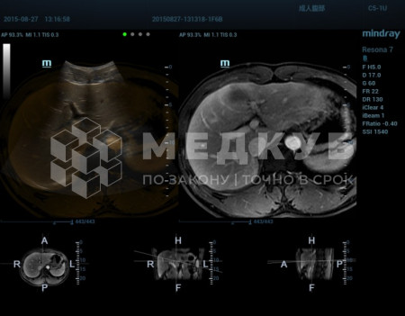 Аппарат УЗИ (сканер) Mindray Resona 7s medcub