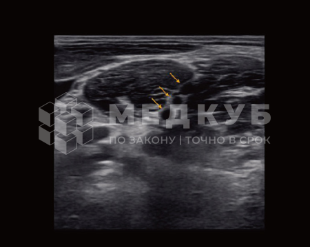 Аппарат УЗИ (сканер) Chison Qbit 8 medcub
