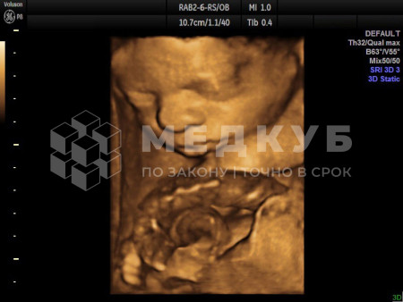 Аппарат УЗИ (сканер) GE Healthcare Voluson P8 medcub