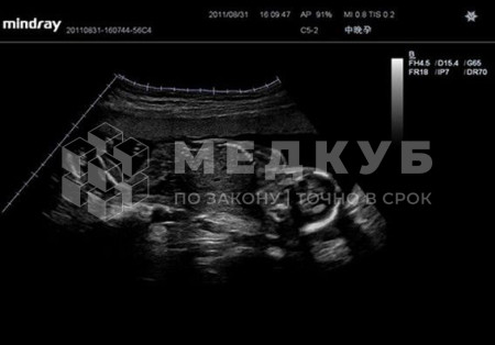 Аппарат УЗИ (сканер) Mindray Resona 7 medcub