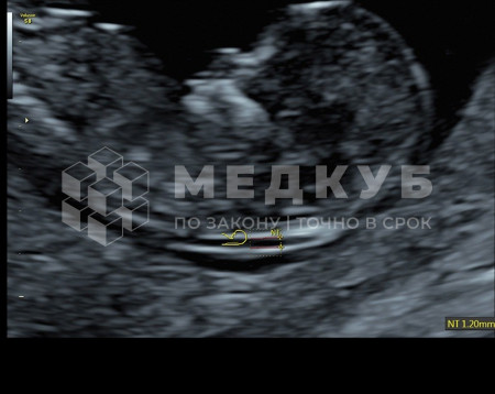 Аппарат УЗИ (сканер) GE Healthcare Voluson S8 medcub